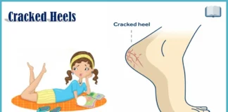 Cracked Heels Remedies in Hindi