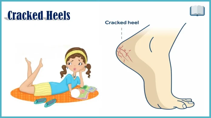 Cracked Heels Remedies in Hindi